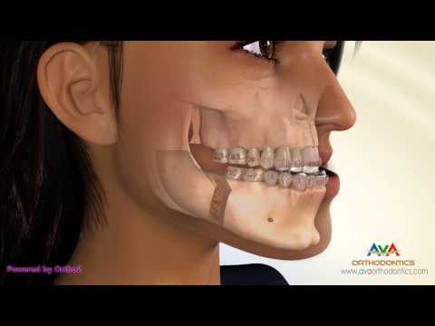 Surgical Orthodontic Treatment for Underbite or Crossbite - BSSO Mandibular Setback