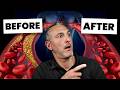 Nattokinase Benefits They Want Hidden | Spike? Plaque? Cholesterol? What Dose? (Study Confirmed)