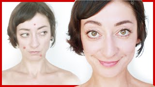 ♥ Pickel weg über Nacht! ES FUNKTIONIERT :D