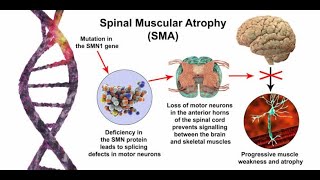 Spinal Muscular Atrophy (Infantile Motor Neuron Disease)