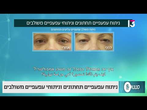ניתוח עפעפיים תחתונים וניתוחי עפעפיים משולבים