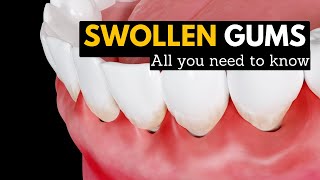 Swollen Gums Explained: What You Need to Know and How to Treat Them