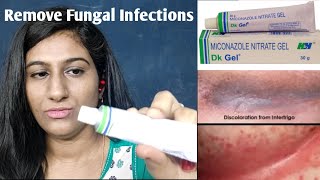 Rash Under Breast: How to Get Rid of Red Itchy Rash Under Breast Telugu | Lucky Selfcare Experients