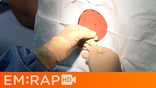Download lagu Lumbar Puncture Tutorial mp3