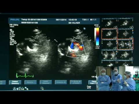 LIVE CASE 4 PDA closure with Amplatzer duct occluder Levent Saltık, Abdullah Erdem