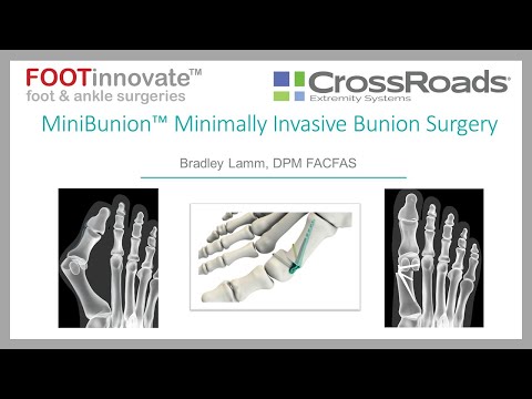 Crossroads Extremity Systems: MiniBunion™ Minimally Invasive Bunion Surgery with Bradley Lamm, DPM