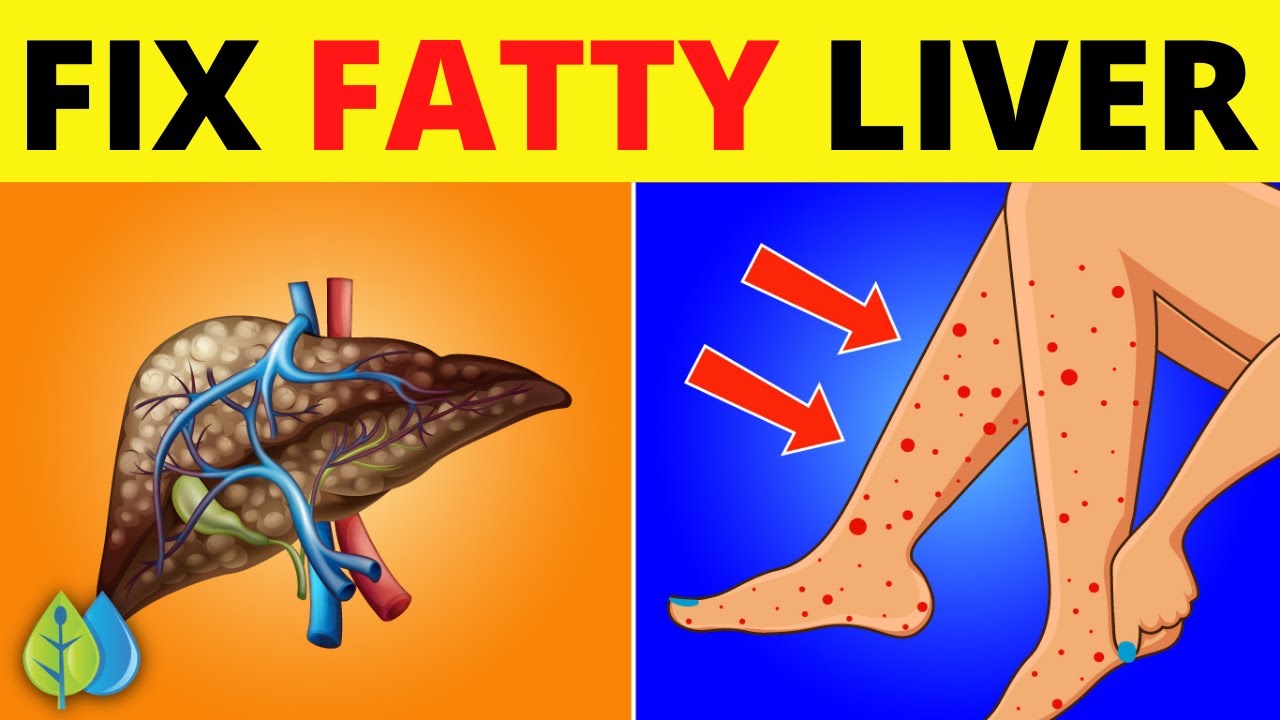 7 Signs And Symptoms Of Fatty Liver Disease & Treatment to Reverse Naturally
