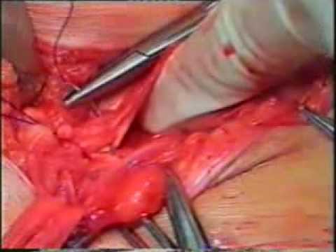 Tension free indirect inguinal hernia surgery without mesh-Dr. Desarda Repair