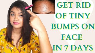 How to Get Rid of Tiny Bumps on Face Naturally | Home Remedy To Treat Fungal Acne | Remove Tiny Bump