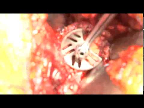 Behandlung von Bandscheibenbruch. Thorax Kontraktur des Handgelenkes und der Hand