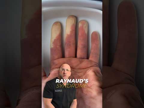 More Than Just Pale Fingers and Toes - Raynaud’s Syndrome #shorts