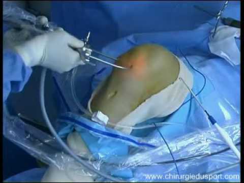 comment renforcer les ligaments epaule
