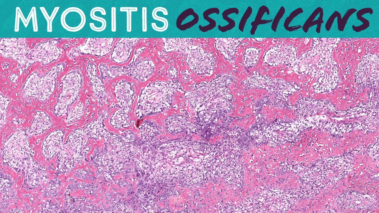 Myositis Ossificans (benign mimic of sarcoma) bone/soft tissue pathology & radiology correlation