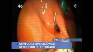 GASTROVITAL: Cirugía POSE en  - Dr. Carlos Silva González