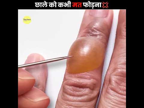 छाला कभी मत फोड़ना 💢 | Don't Burst Blisters | The Fact | #shorts #ytshorts