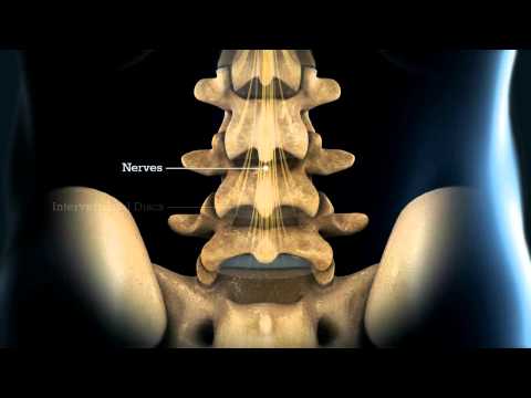 LESI (Lumbar Epidural Steroid Injection) -- Larry Parker M.D.
