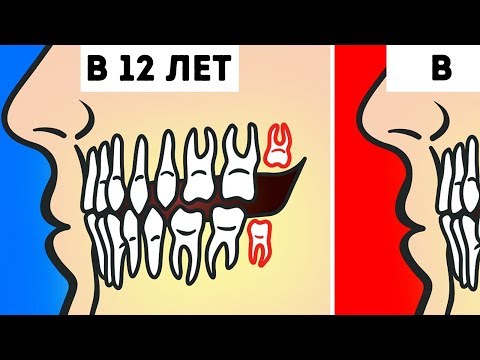 Действительно ли Нужно Удалять Зубы Мудрости?