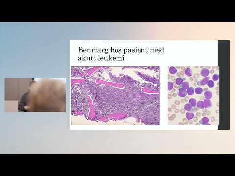 AML - utredning og behandling, ved Tor Henrik Andersson Tvedt, seminar om AML og ALL 18.09.25