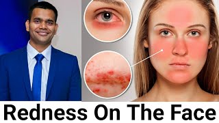 Redness On The Face - Rosacea, My Opinion And Natural Treatment
