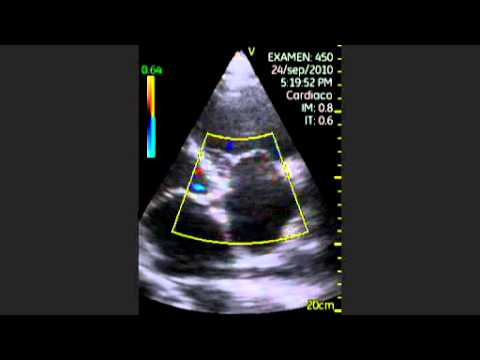 Tricuspidal Valve Impairment