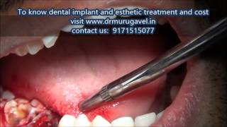 preview picture of video 'immediate extraction and implant placement in chennai'