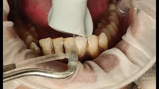 Teeth cleaning: removing tough smoking stains