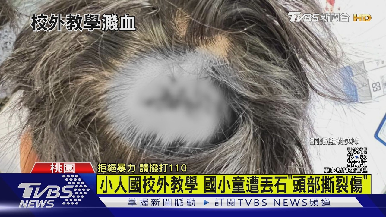 影音/校外教學變調!童遭丟石頭「撕裂傷逢3針」 家長質疑延誤送醫