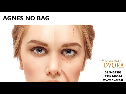Un rossore di occhio in occhi si è gonfiato Girudoterapiya in cosmetology sulla persona