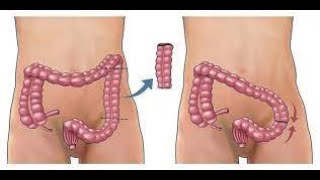 Colectomy CPT code - simplify medical coding