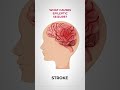 What Causes Epileptic Seizures