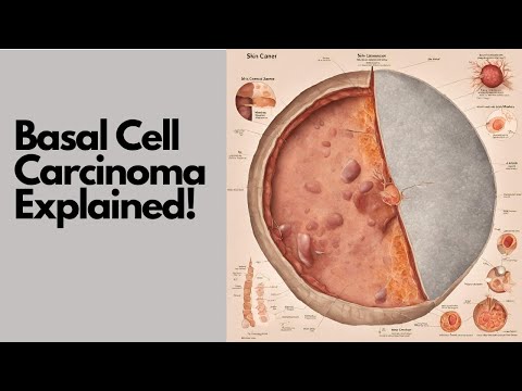 EDUCATIONAL VIDEO | Basal Cell Carcinoma Wikipedia Audio Article | Skin Cancer Biology Explained!