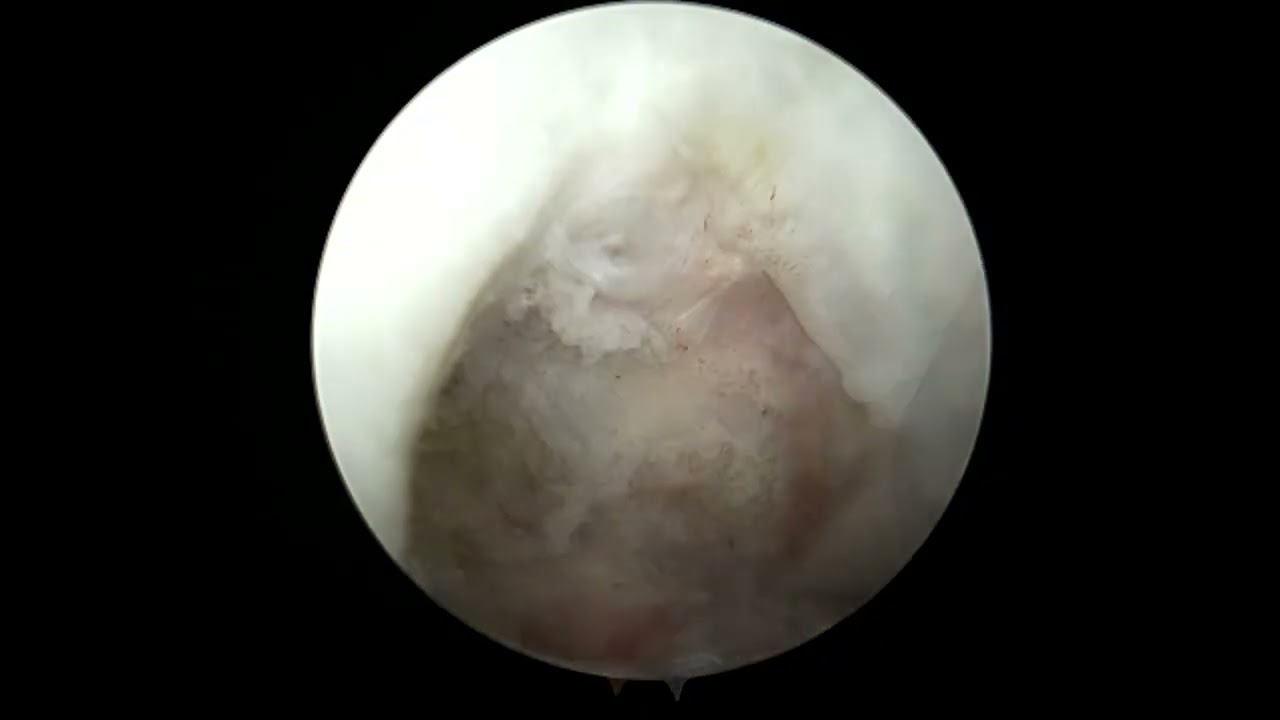 Dr. Garcia demonstrates an ACL repair around a tibial nail