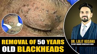 REMOVAL OF 50 YEARS OLD BLACKHEADS II Dr. Lalit Kasana
