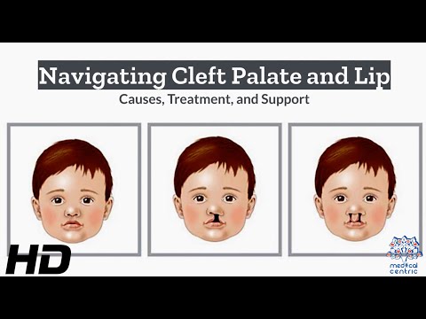 Hydrocephalus Causes Signs and Symptoms Diagnosis and Treatment