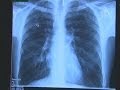 Туберкулёз угрожает Лондону (новости) 