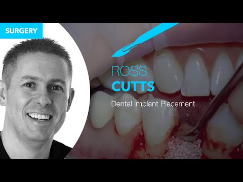 Dental Implant Placement — Step-by-Step Surgical Technique