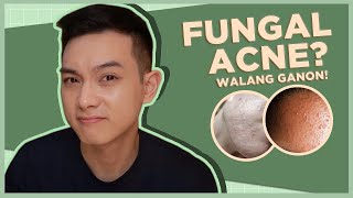SMALL BUMPS ON THE FACE: Fungal Acne Ba Talaga? | Jan Angelo