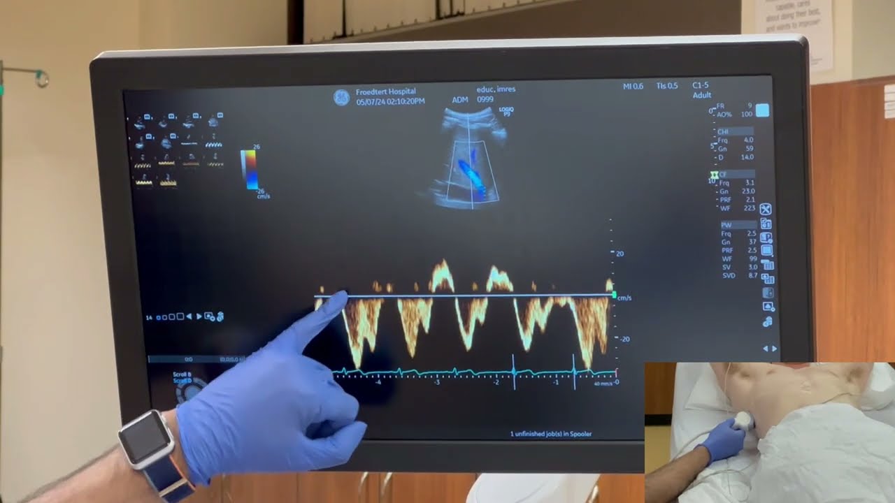 How to perform VExUS scan (Venous Excess Ultrasound) I Dr. Koratala I POCUS