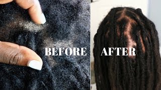How To REMOVE Flakes and Dandruff |  Extremely DRY SCALP Psoriasis & Dermatitis
