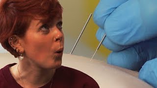 Irish People Try Dry Needling For The First Time