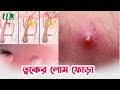 একনি ইনভারসা বা ত্বকের লোম ফোড়া রোগে�