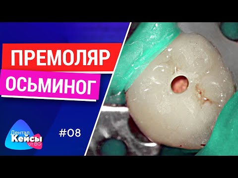 Премоляр осьминог | Дентал Кейсы от BG #08