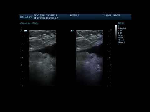 iNeedle (кинопетли) iNeedle (кинопетли)