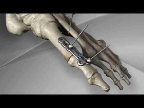 Schmerzen im Nacken Nacken erhöhtem Druck Spondiloartroz Lesungen und Osteochondrose