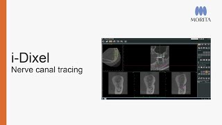 Learn how to utilize the nerve canal marking tool in i-Dixel to indicate the mandibular canal for patient presentation and implant presentation.