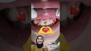 Download lagu GIGI DEPAN BERLUBANG, TAMBAL GIGI DEPAN ESTETIK mp3