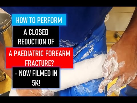 TRAUMA: How to perform a Closed Reduction of a Paediatric Forearm Fracture