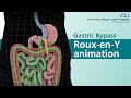 Gastric Bypass Roux En Y Animation