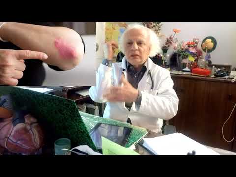 Marche nordique dans lhypertension La tachycardie à lhypotension