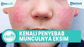 Kenali Penyebab Munculnya Eksim pada kulit, Begini Cara Pencegahan agar Tidak Gatal